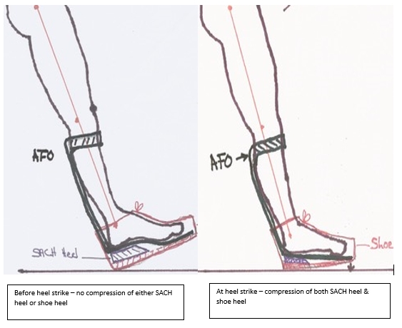 A diagram with a close-up view of the 'heel strike' while wearing an AFO brace.
